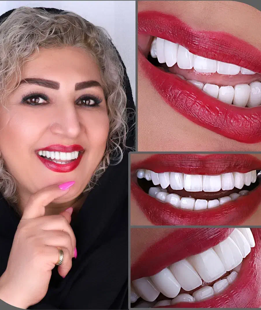 ایمپلنت بلندمدت/کامپوزیت/لمینت/درمانی|خدمات آرایشگری و زیبایی|مرند, |دیوار