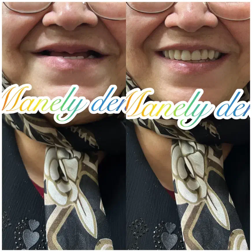 دندان مصنوعی ۲۰٪تخفیف|آرایشی، بهداشتی، درمانی|آمل, |دیوار