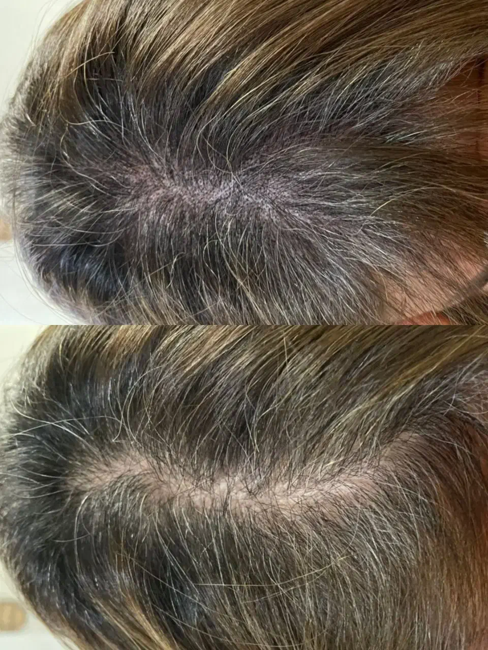 راه نجات کم‌پشتی مو با میکرواسکالپ|خدمات آرایشگری و زیبایی|دزفول, |دیوار