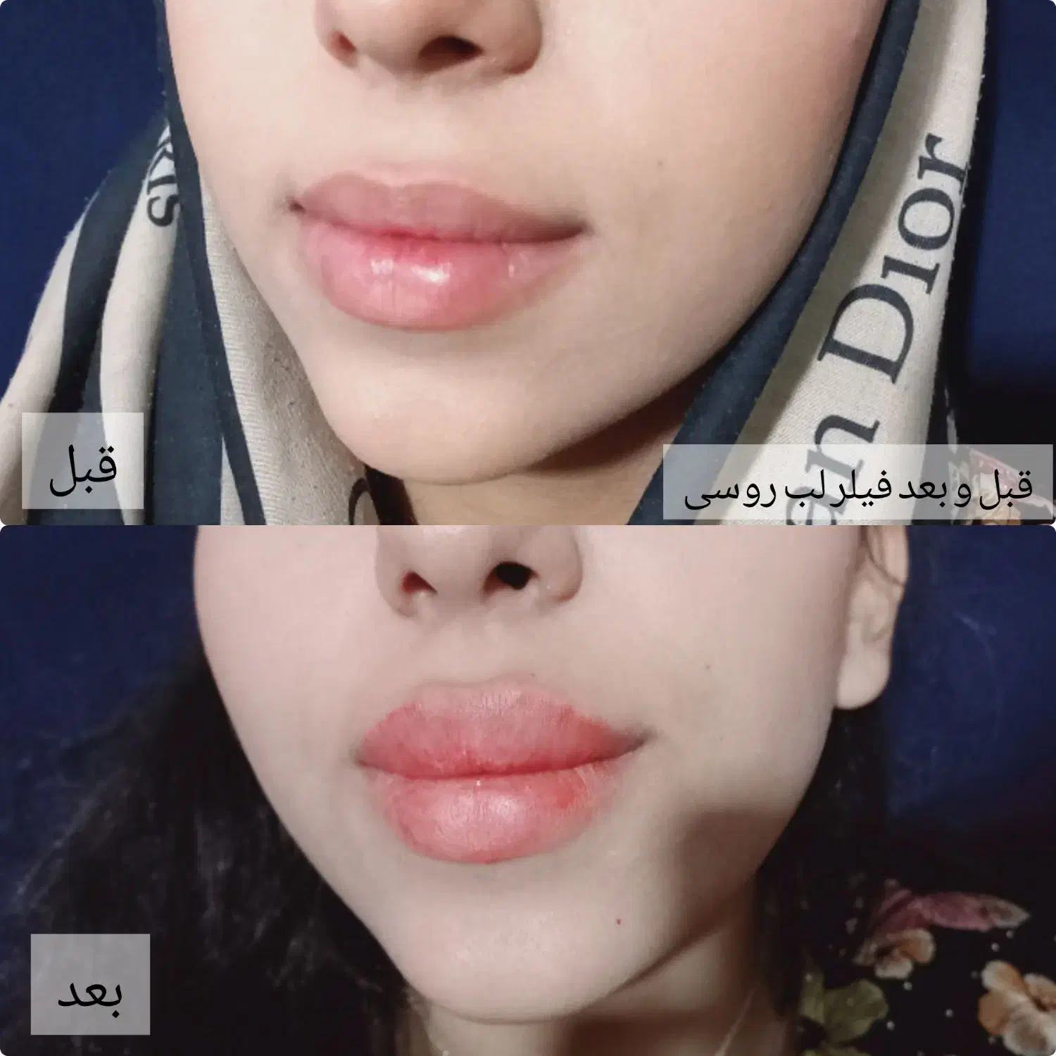 انجام تمامی خدمات فیلر و بوتاکس|خدمات آرایشگری و زیبایی|سبزوار, توحیدشهر|دیوار