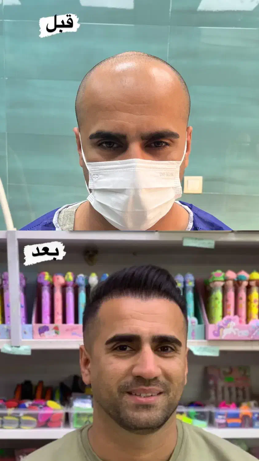 کاشت مو فول تراکم تضمینی|خدمات آرایشگری و زیبایی|گرگان, |دیوار