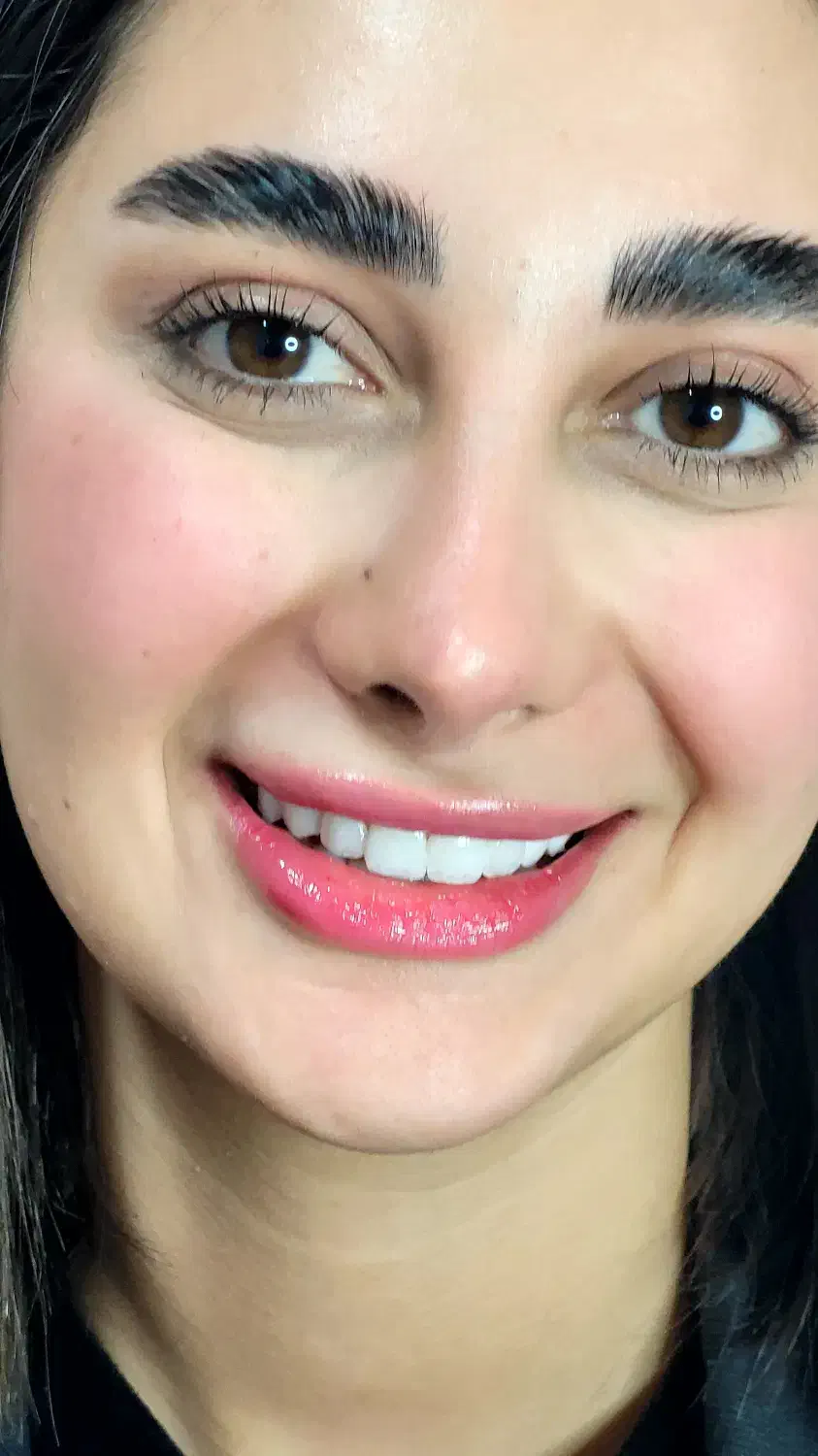 کامپوزیت زیبایی دندان|خدمات آرایشگری و زیبایی|رشت, دباغیان|دیوار