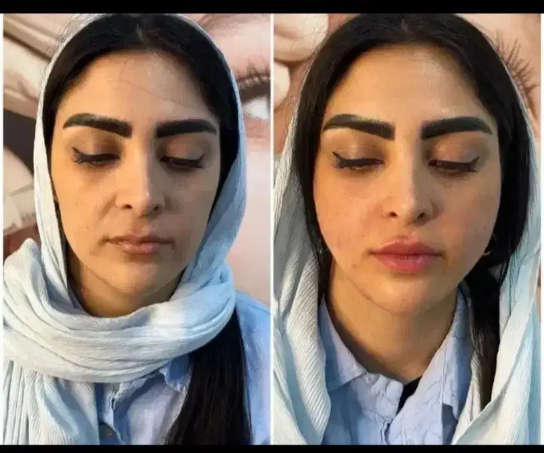 زاویه سازی.ژل.فیلر.نخ.انزیم مزو بوتاکس دکتر داریوش|خدمات زیبایی و سلامت|مشهد, گوهرشاد|دیوار