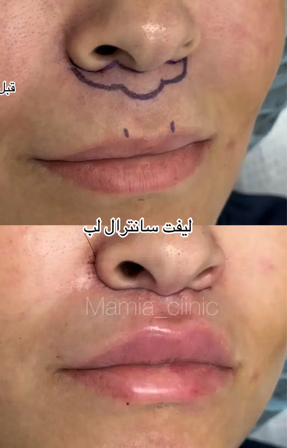 تزریق ژل و بوتاکس-چربی|خدمات آرایشگری و زیبایی|اهواز, کیانپارس |دیوار