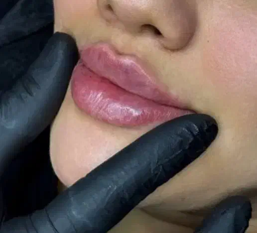 تزریق ژل وفیلر|خدمات آرایشگری و زیبایی|رباطکریم, رباطکریم|دیوار