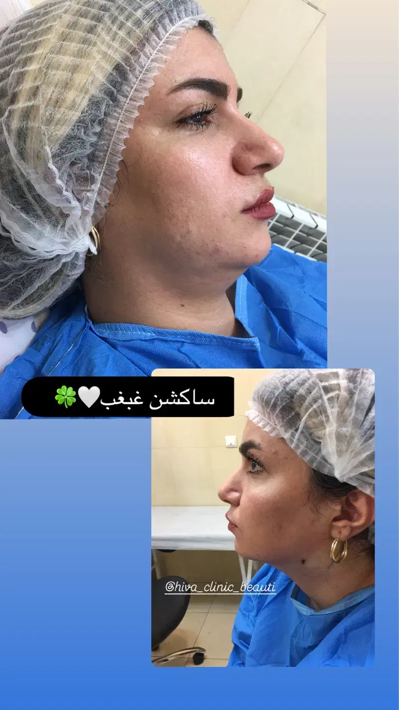 آموزش،پی ار پی مزوبوتاکس بایوفیلر غبغب چربی ساکشن|خدمات آرایشگری و زیبایی|اصفهان, شاهزید|دیوار