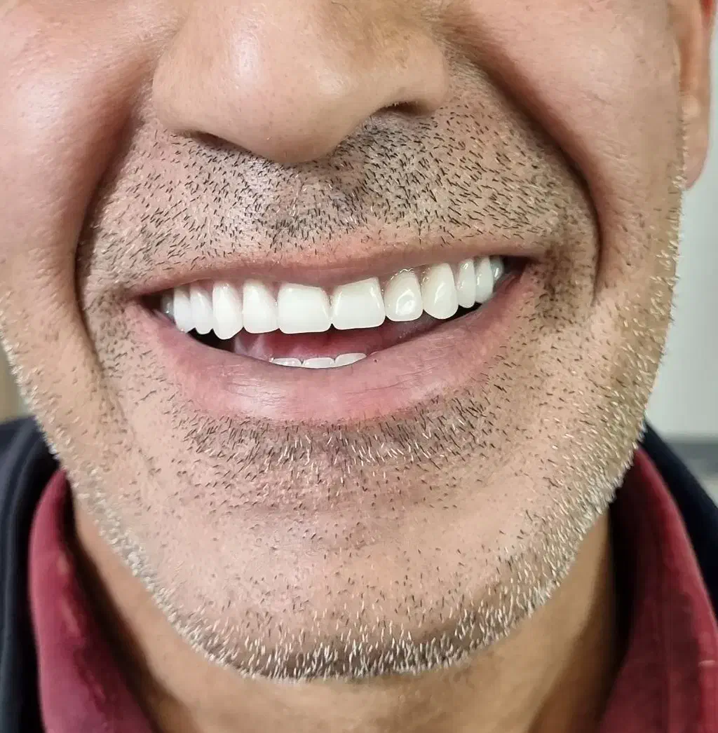 دندان مصنوعی (دست دندان)|خدمات آرایشگری و زیبایی|مرند, |دیوار