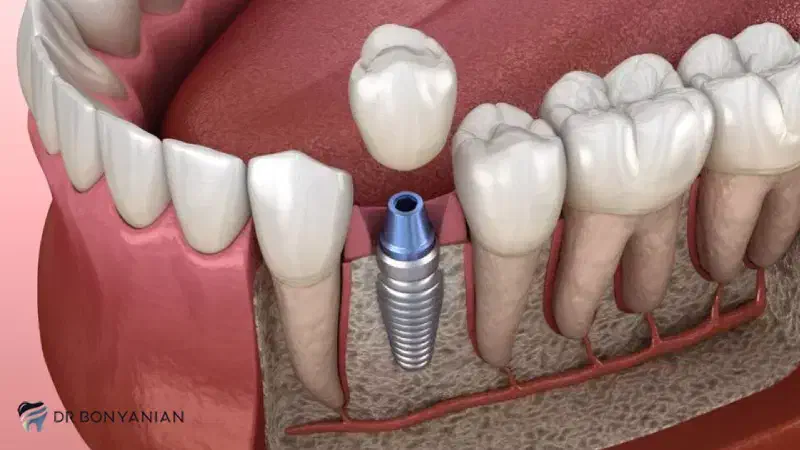 ایمپلنت دندان سوئیسی|آرایشی، بهداشتی، درمانی|تهران, قیطریه|دیوار