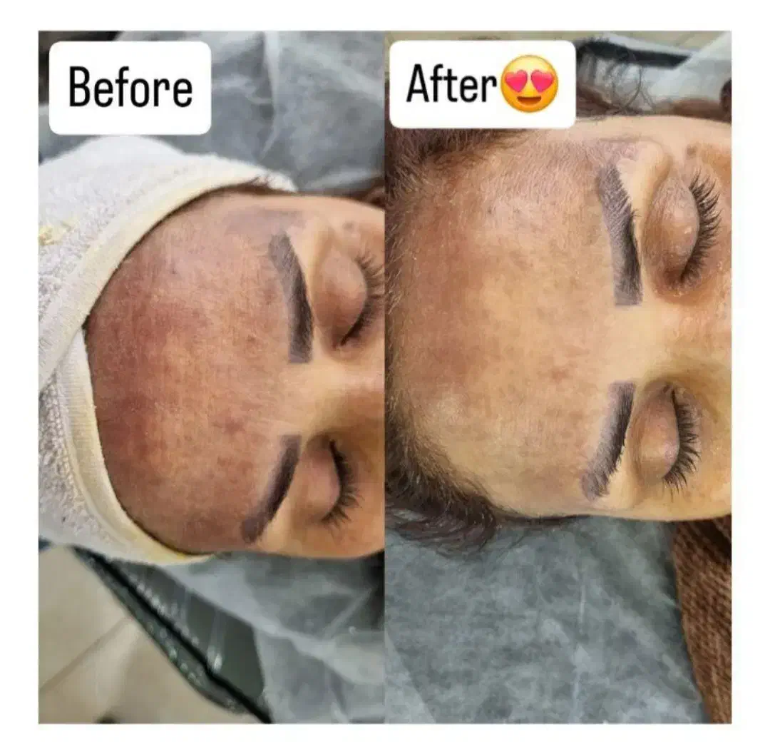 مزوندلینگ ،میکرونیلدینگ و درمان تخصصی لک|خدمات آرایشگری و زیبایی|بیرجند, |دیوار