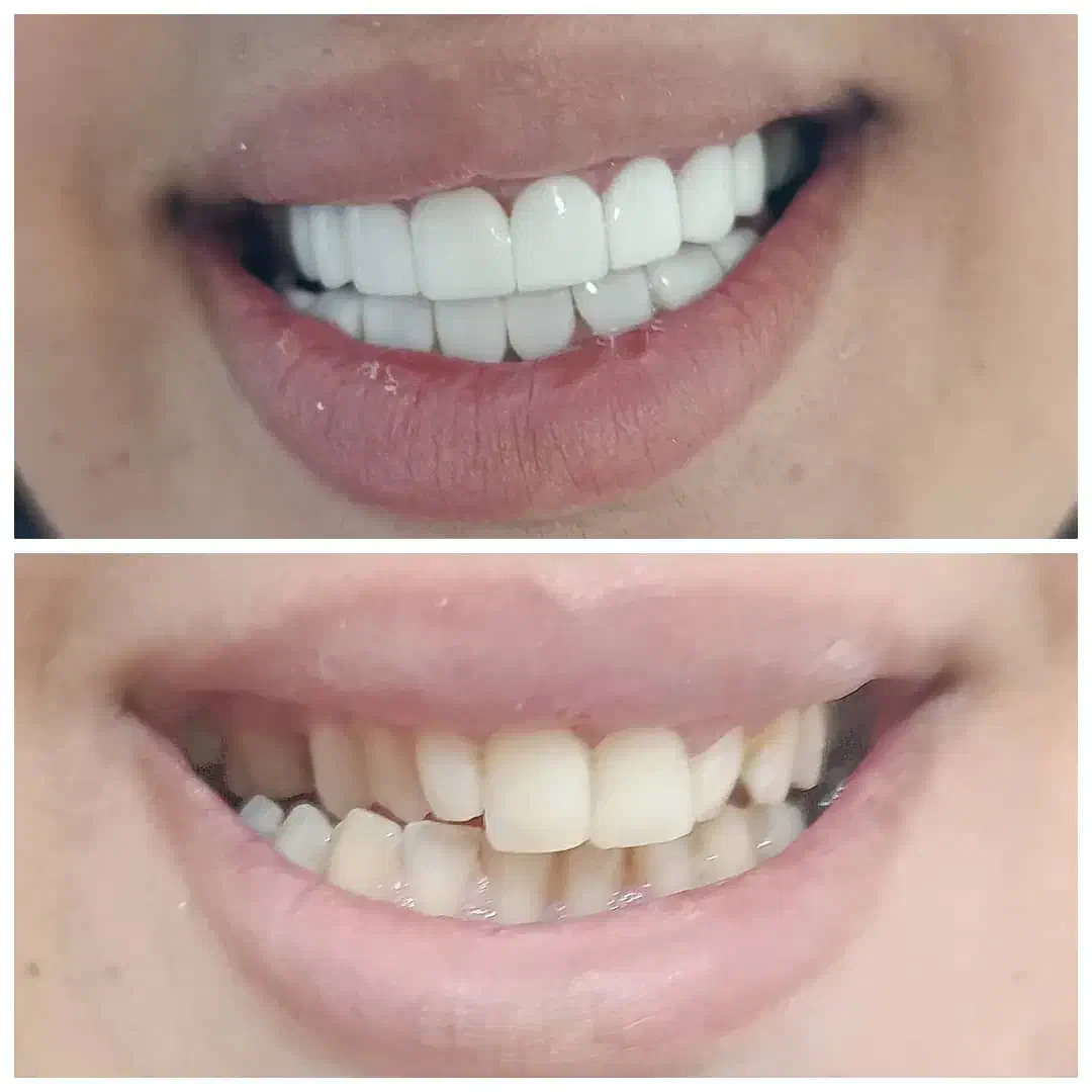 کامپوزیت دندان با بهترین کفیت با قیمتی مناسب|خدمات آرایشگری و زیبایی|یاسوج, |دیوار