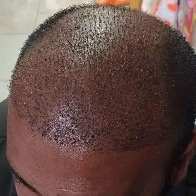 کاشت مو و ابرو|خدمات آرایشگری و زیبایی|سراب, |دیوار