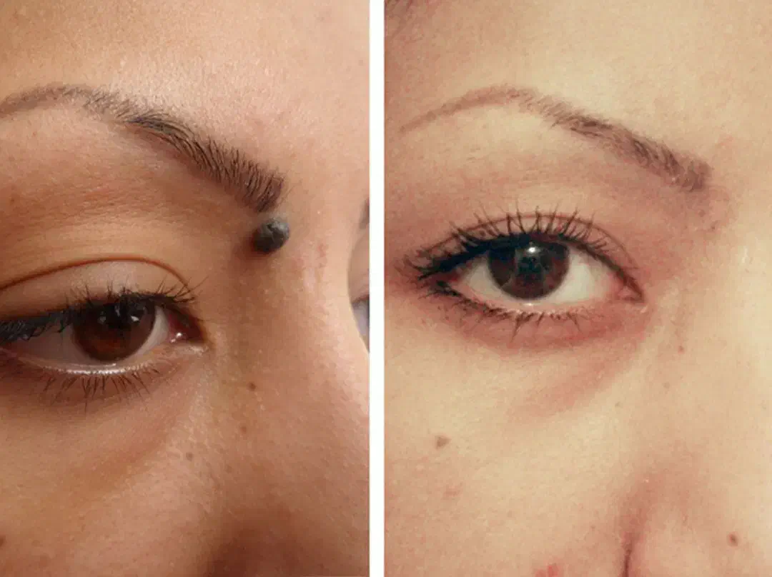 خال برداری|خدمات آرایشگری و زیبایی|جیرفت, |دیوار