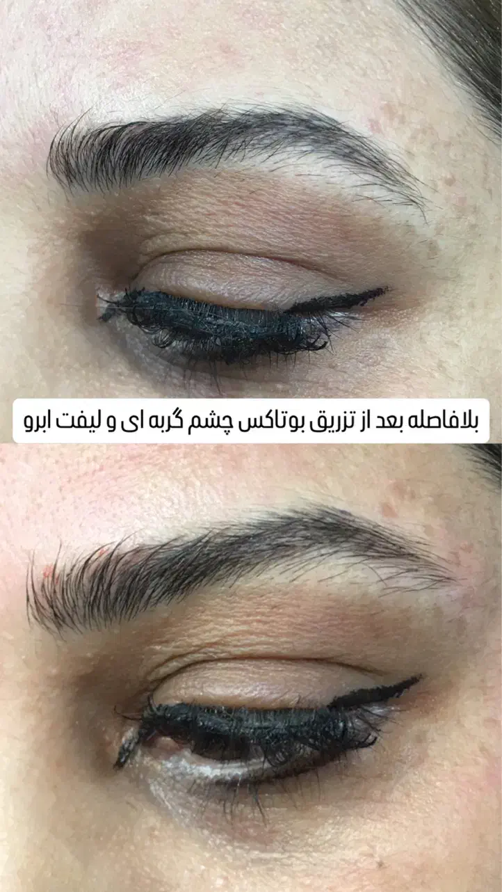 تزریق بوتاکس و فیلر|خدمات آرایشگری و زیبایی|رشت, خواهر امام|دیوار