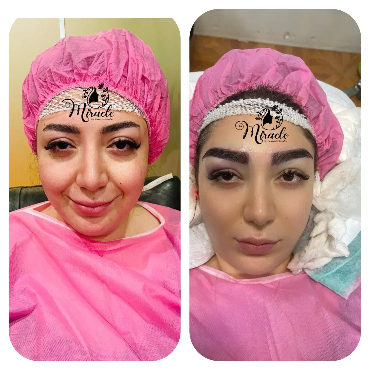 کاشت مو و ابرو طبیعی و متقارن و اصولی در یزد|خدمات آرایشگری و زیبایی|یزد, |دیوار