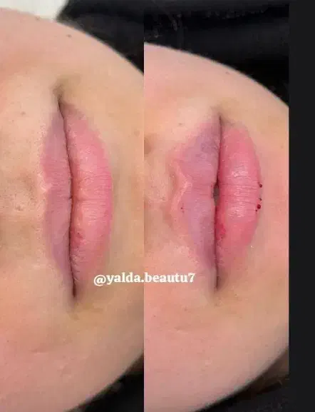 تزریق ژل و بوتاکس|خدمات آرایشگری و زیبایی|بابل, |دیوار
