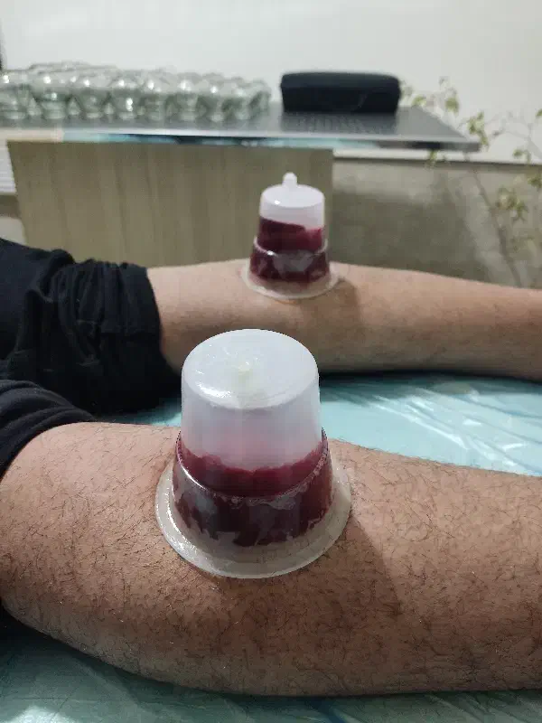 حجامت، زالودرمانی،بادکش درمانی در پرند|خدمات آرایشگری و زیبایی|پرند, فاز ۵|دیوار