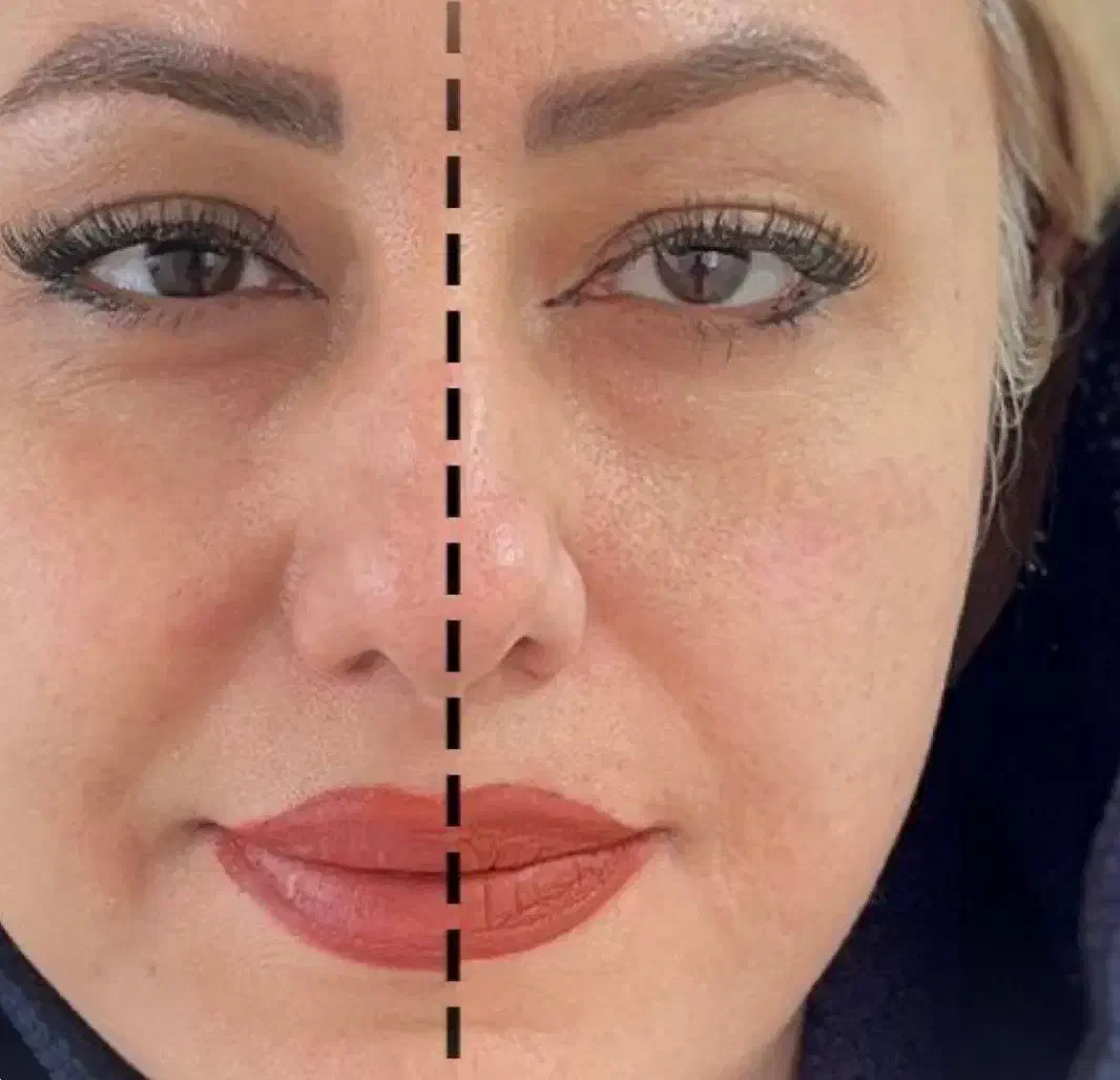 هایفوتراپی در مطب پزشک با قیمتی باورنکردنی|خدمات آرایشگری و زیبایی|مشهد, چهارچشمه|دیوار