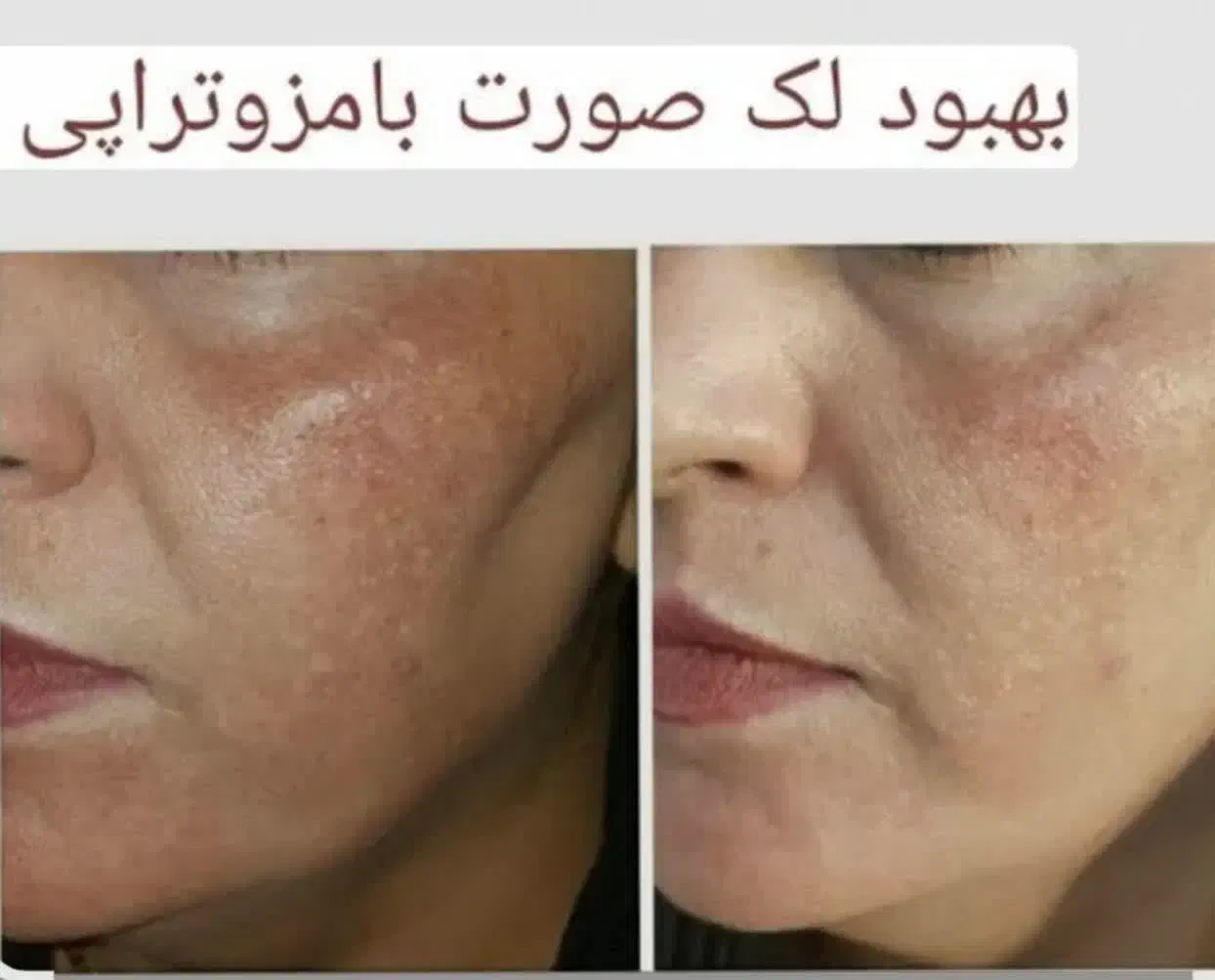 آموزش تخصصی فیشیال،مزوتراپی،خالبرداری|خدمات آرایشگری و زیبایی|خمینی‌شهر, |دیوار