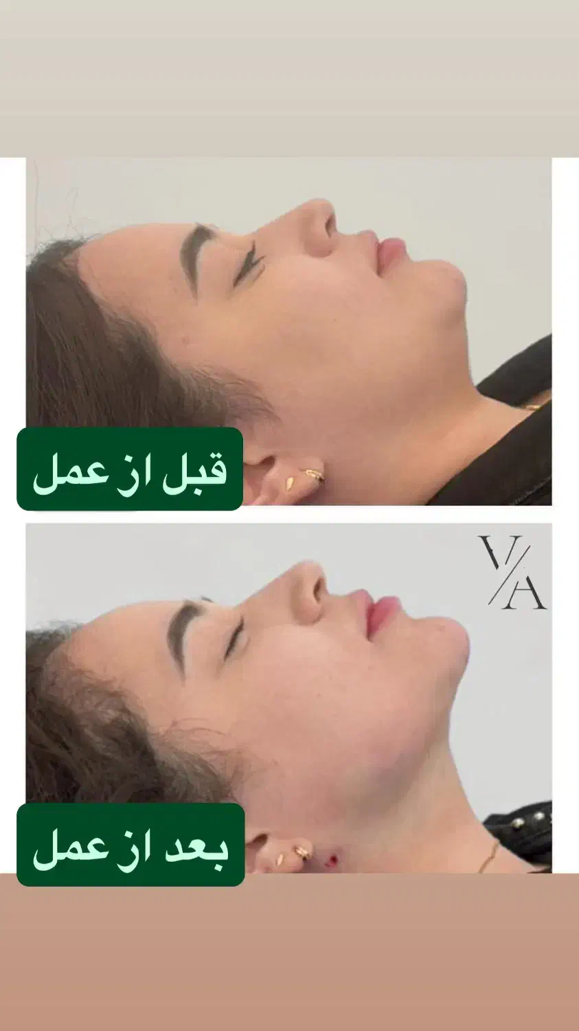 جشنواره تخفیفی لیپوماتیک بلفاروپلاستی و لیپوبازو|خدمات آرایشگری و زیبایی|تهران, ونک|دیوار