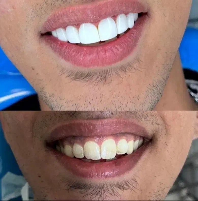 کامپوزیت دندان جشنواره ی تخفیفات تا شب یلدا|خدمات آرایشگری و زیبایی|رشت, معلم|دیوار