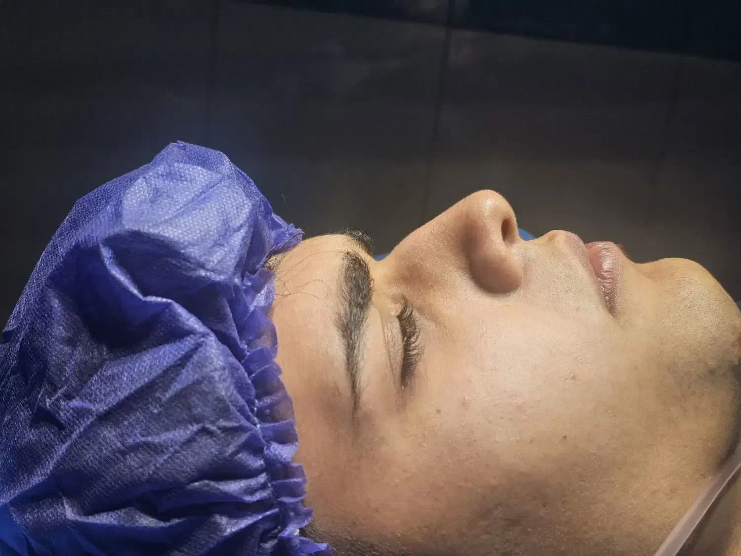 جراحی بینی توسط دکتر متخصص امیر اسدالله پور|پزشکی|قائمشهر, |دیوار