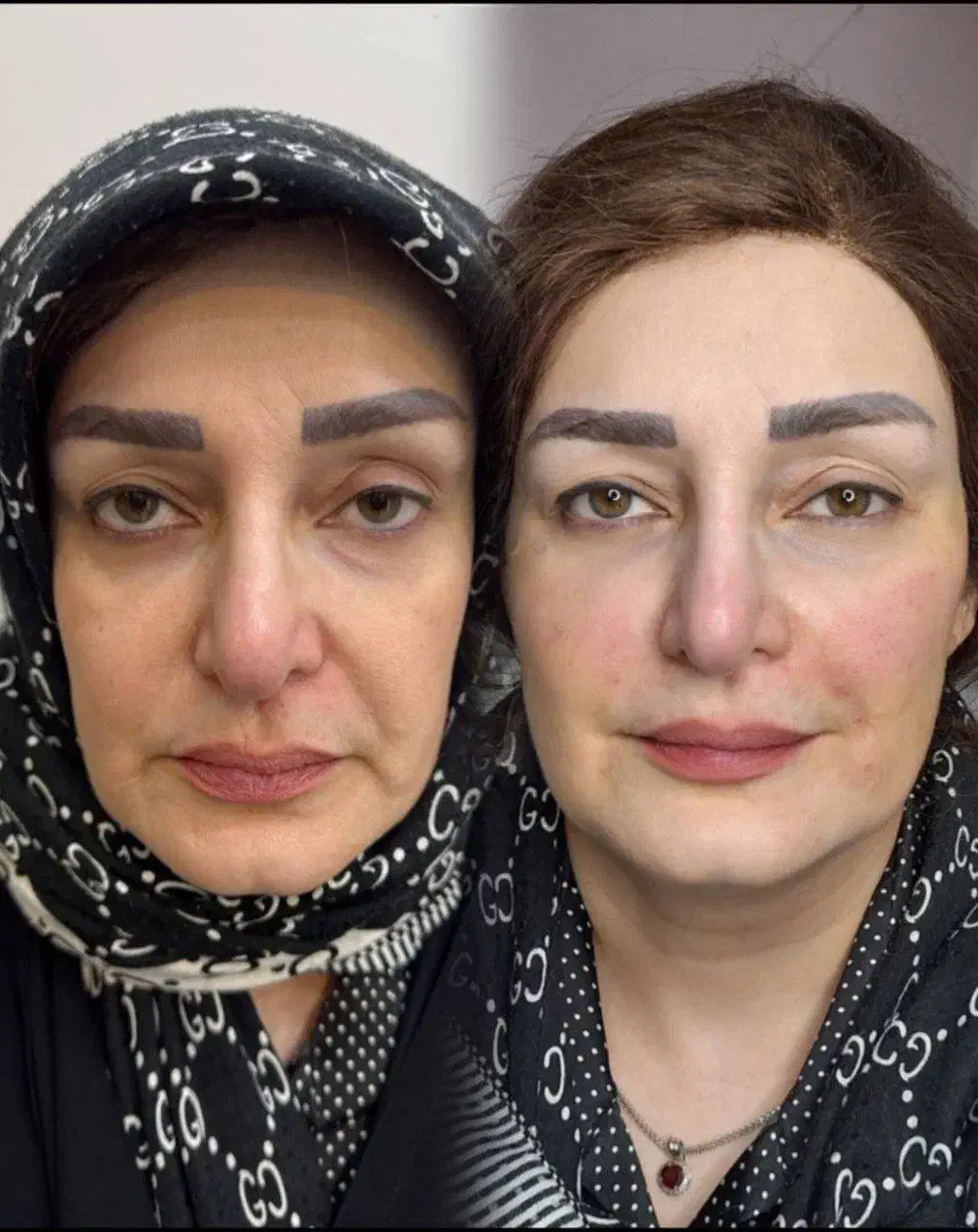 جشنواره تزریق ژل و لیفت صورت|خدمات آرایشگری و زیبایی|قم, زنبیل آباد|دیوار