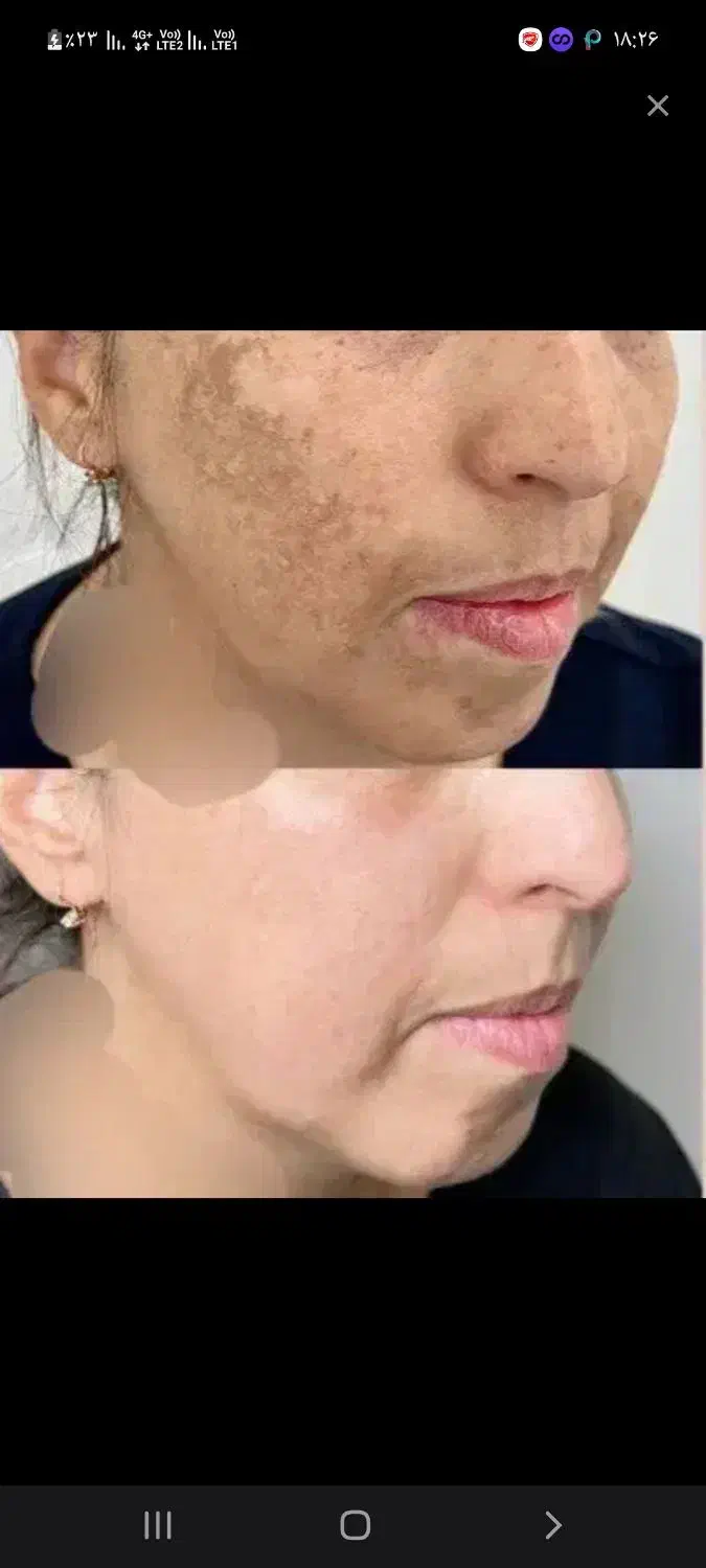 با تیرگی خداحافظی کن|آرایشی، بهداشتی، درمانی|رشت, پسیخان|دیوار