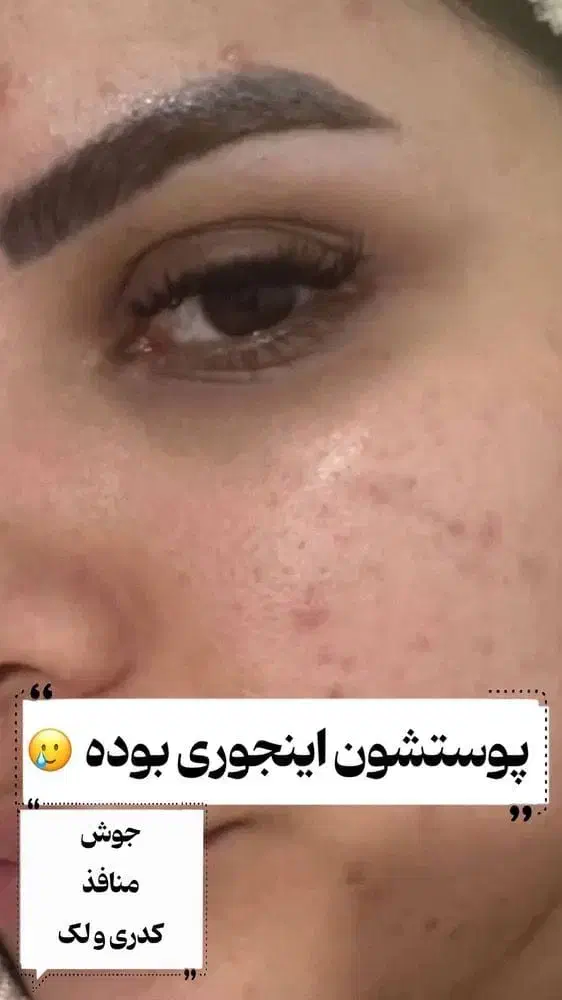 پووست موو|آرایشی، بهداشتی، درمانی|چیتاب, |دیوار