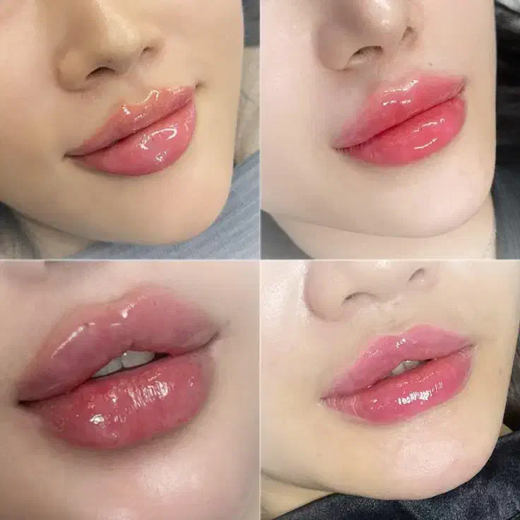 تزریق ژل لب روسی طبیعی توسط پزشک متخصص|خدمات آرایشگری و زیبایی|چهاردانگه (تهران), |دیوار