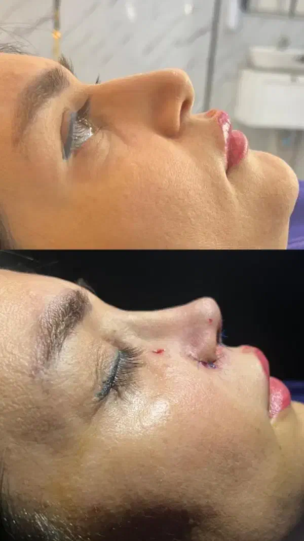 آف ویژه زیبایی بینی|خدمات آرایشگری و زیبایی|بهبهان, |دیوار