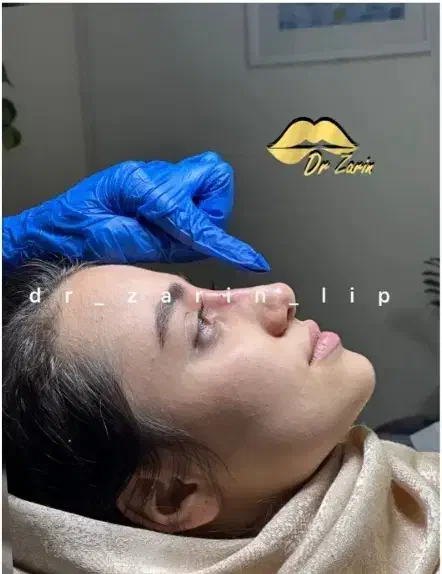 فیلربینی بوتاکس نخ ابرو لب روسیMزاویه ژل گونه پزشک|خدمات آرایشگری و زیبایی|تهران, الهیه|دیوار