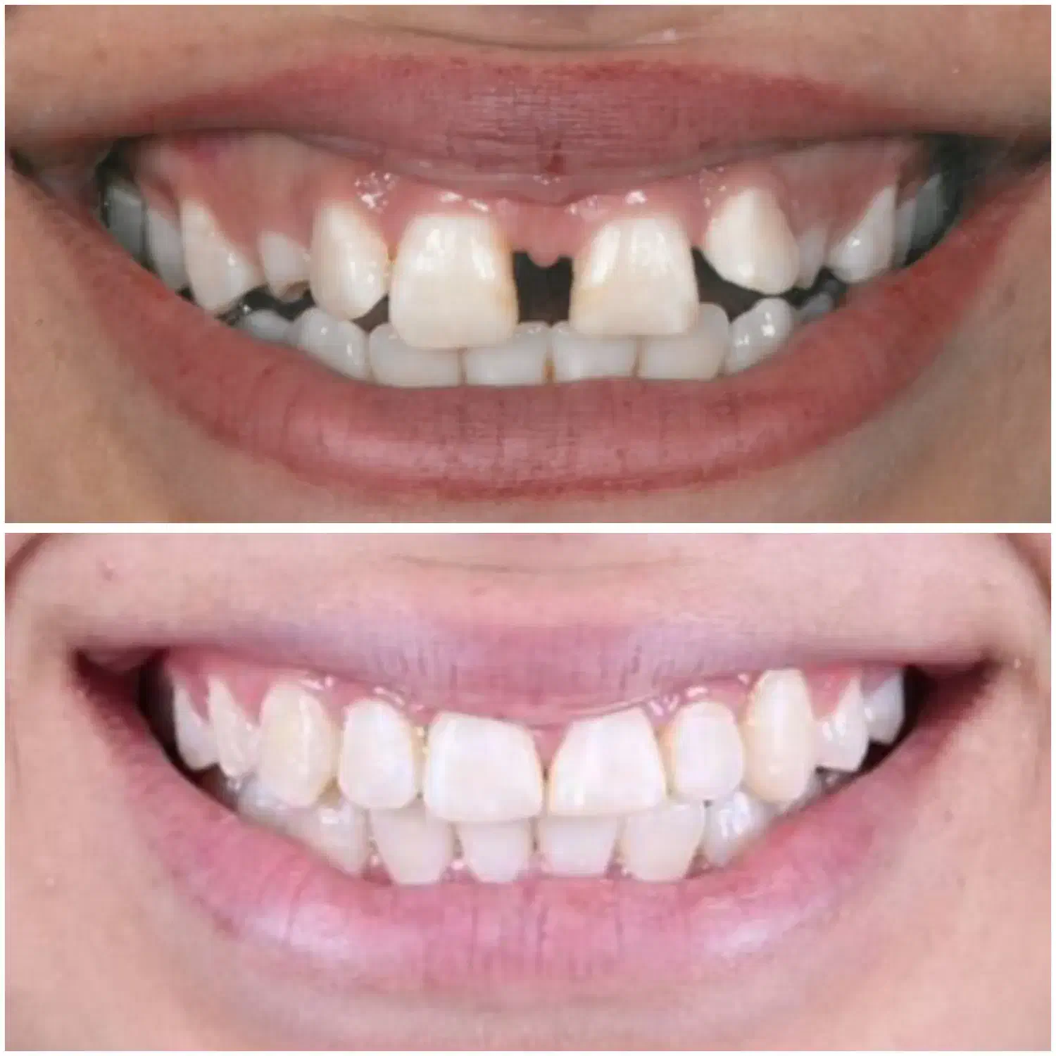 اورتودنسی دندان/۱۰م تخفیف/اقساط بدون سود|خدمات آرایشگری و زیبایی|فسا, |دیوار