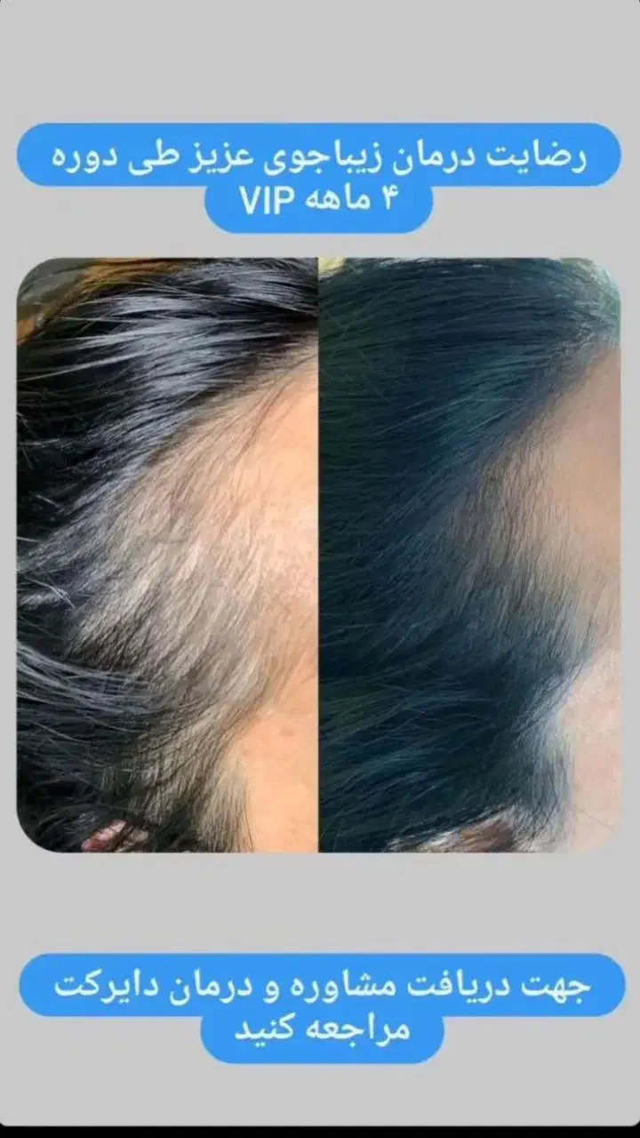 قطع ریزش مو و پرپشتی مو فقط با تکنیک اکسونیک|آرایشی، بهداشتی، درمانی|بوشهر, |دیوار