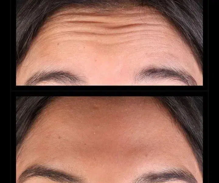 جشنواره تزریق ژل و بوتاکس در کلینیک فقط۶۰۰|خدمات آرایشگری و زیبایی|ساری, |دیوار