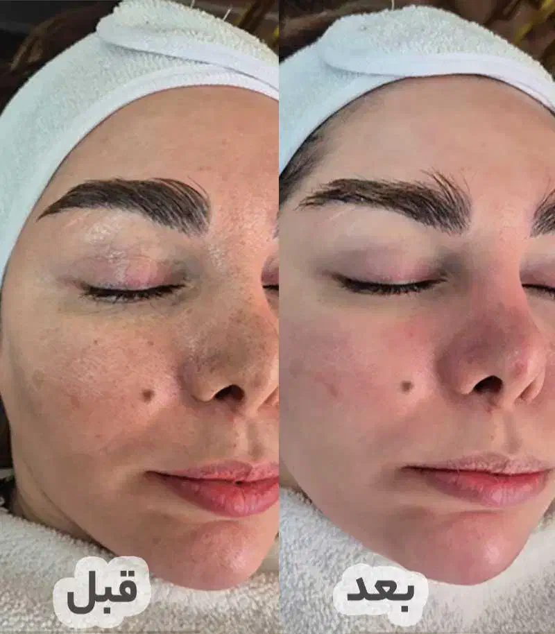 آف ویژه فیشال پوست|خدمات آرایشگری و زیبایی|شیراز, ریشمک|دیوار