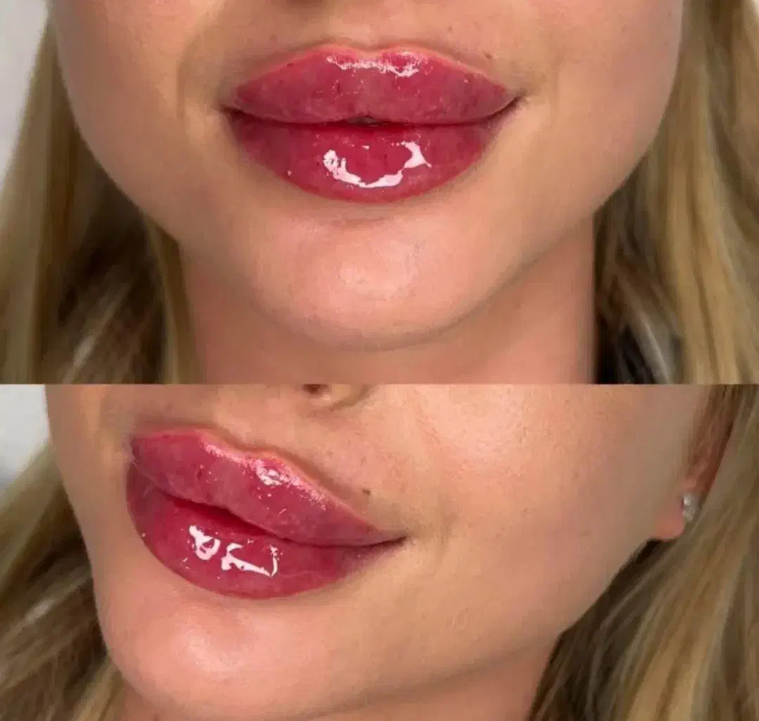 تزریق فیلر،ژل،بوتاکس|خدمات آرایشگری و زیبایی|کرمانشاه, |دیوار