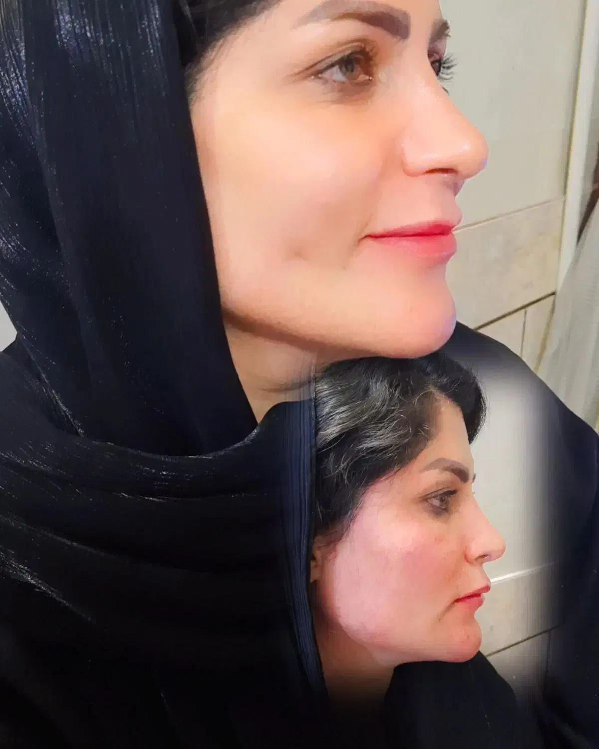 تزریق ژل بوتاکس مزو نخ جوانساز باقیمت مناسب درمنزل|خدمات آرایشگری و زیبایی|شهرضا, |دیوار