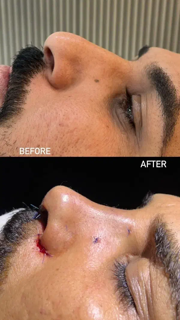 آف ویژه زیبایی بینی|خدمات آرایشگری و زیبایی|بهبهان, |دیوار