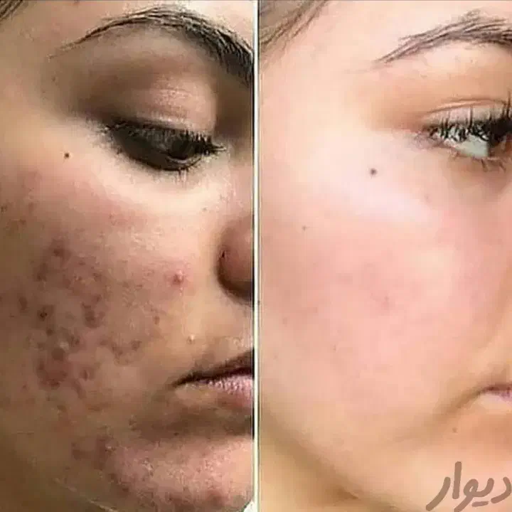 کرم معجزه شب اصل رفع لک وجوش وسفیدشدن پوست|آرایشی، بهداشتی، درمانی|قم, چهار مردان|دیوار