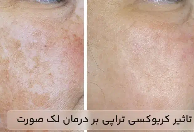 کربوکسی تراپی|خدمات آرایشگری و زیبایی|رفسنجان, |دیوار