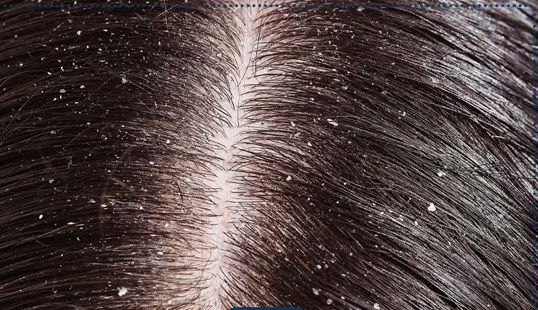 درمان بدون درد سر شوره مو|آرایشی، بهداشتی، درمانی|شادگان, |دیوار