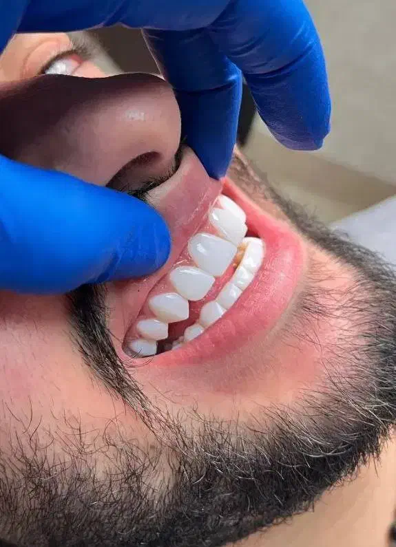 کامپوزیت دندان|خدمات آرایشگری و زیبایی|اردبیل, |دیوار