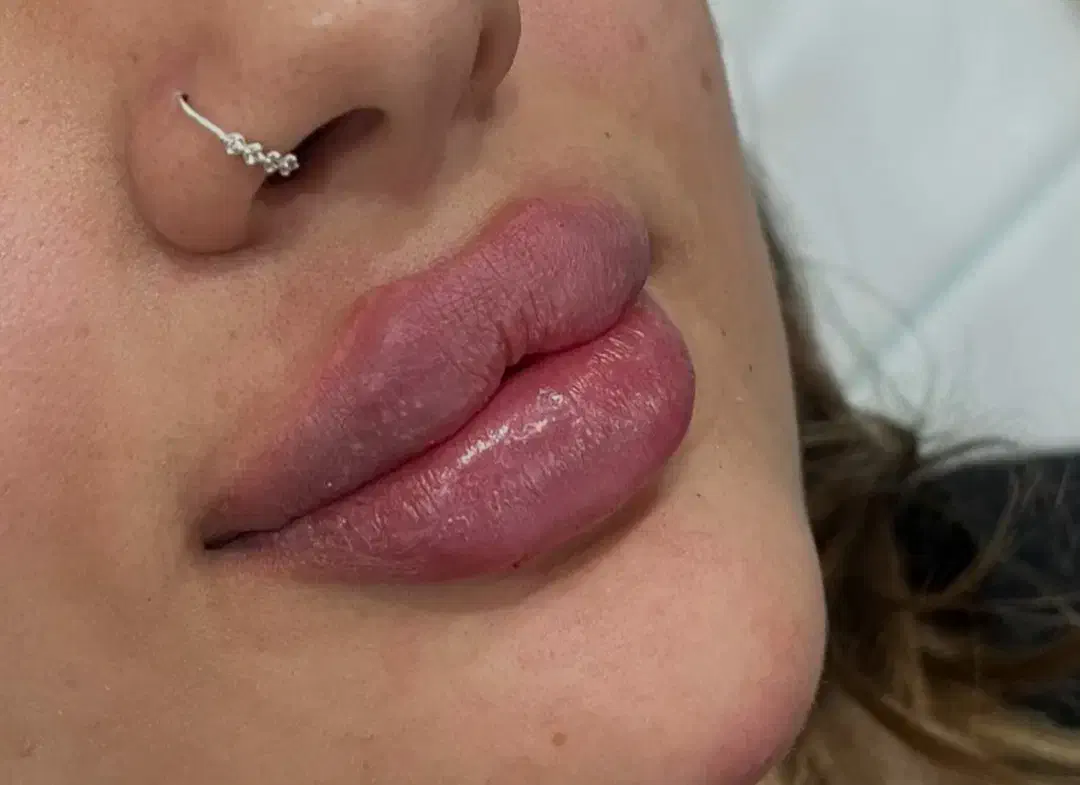 آموزش صفرتا۱۰۰ همه مباحث تزریق فیلر ژل بادی بوتاکس|خدمات آموزشی|شیراز, شریف‌آباد|دیوار
