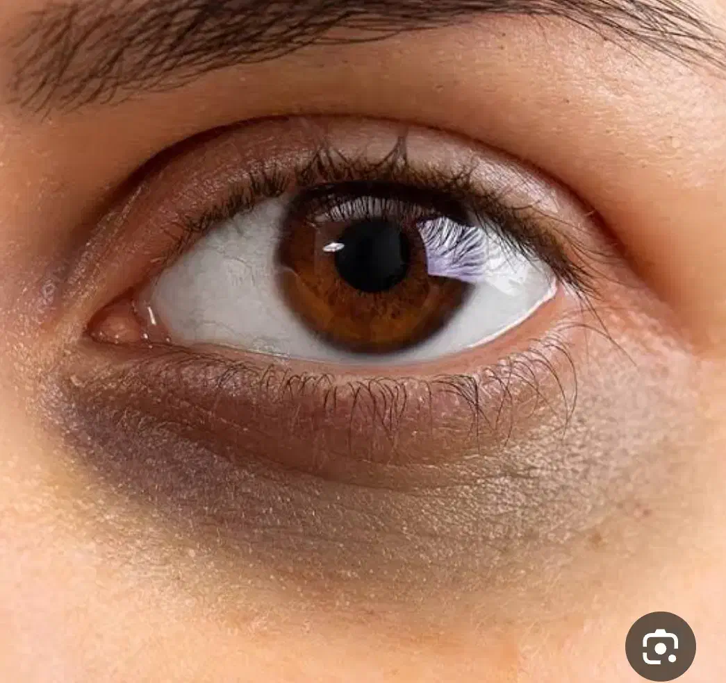 سیاهی وگودی دور چشم|آرایشی، بهداشتی، درمانی|تهران, امانیه|دیوار