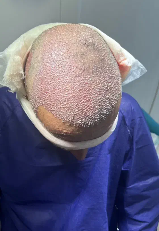 کاشت مو کوهدشت|خدمات آرایشگری و زیبایی|کوهدشت, |دیوار