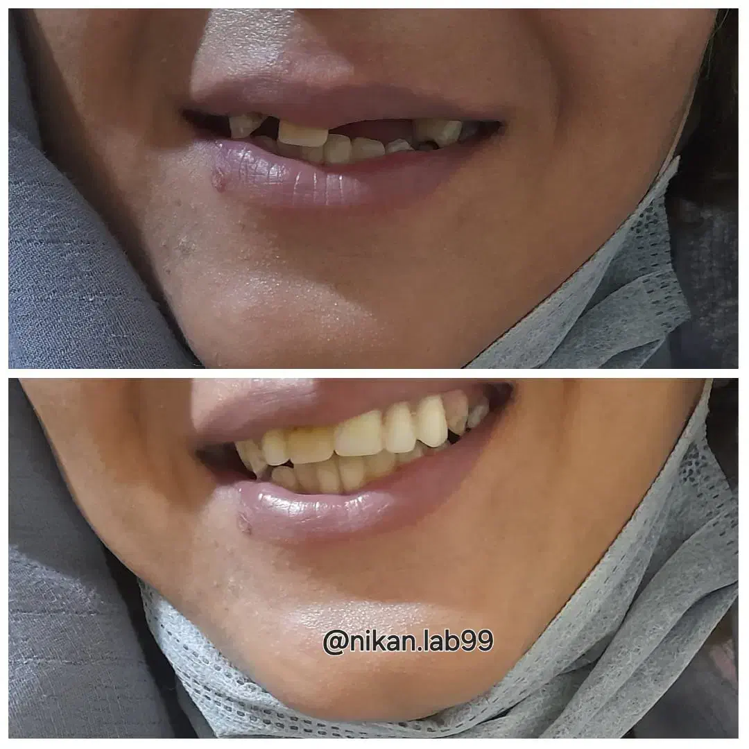 دندانسازی دندان مصنوعی تحویل ۲روزه باضمانت|خدمات آرایشگری و زیبایی|اصفهان, کشاورزی|دیوار