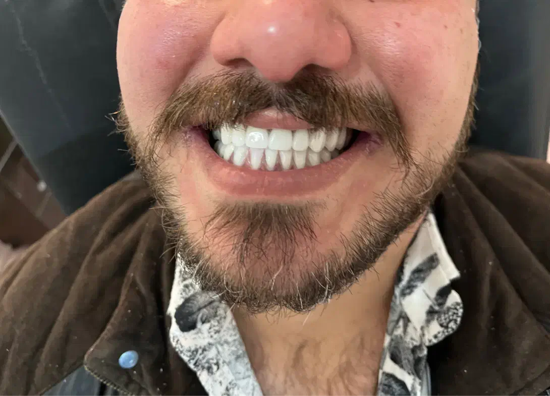 دندان مصنوعی + دندانسازی|خدمات آرایشگری و زیبایی|تهران, شمشیری|دیوار