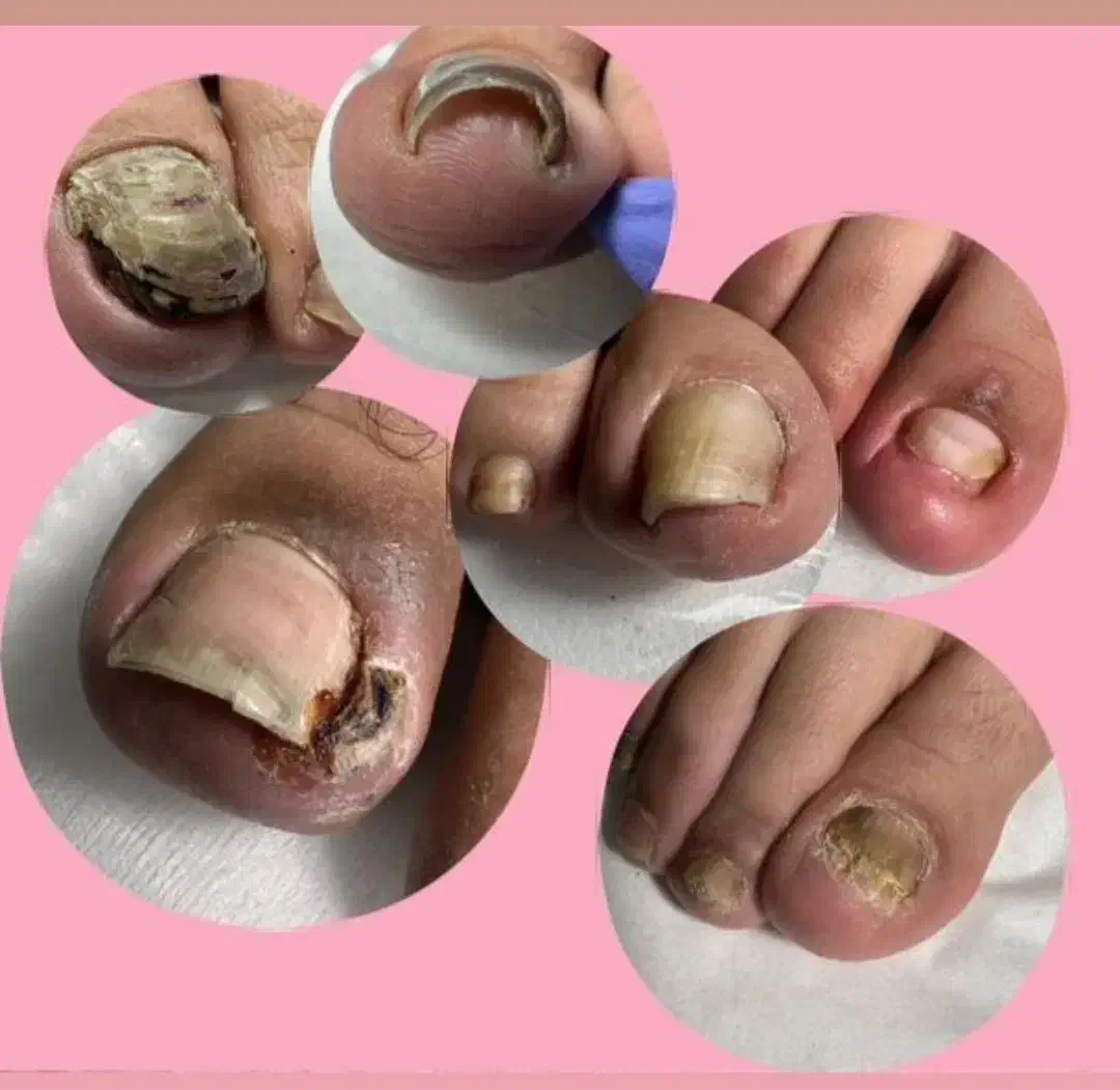 نیازمند مدل برای درمان ناخن پا در کلینیک لوتس|خدمات آرایشگری و زیبایی|تهران, یوسف‌آباد|دیوار