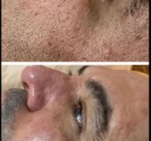 لیزر موهای زائد میکروسویچ و اپلومد کندلا وایتنینگ|خدمات آرایشگری و زیبایی|اصفهان, طامه|دیوار