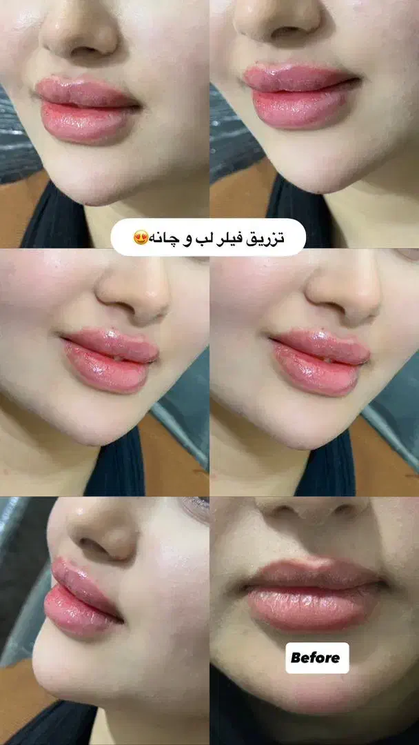 تزریق ژل و بوتاکس و پی ارپی و مزوتراپی و لیزر مو|خدمات آرایشگری و زیبایی|بوشهر, |دیوار